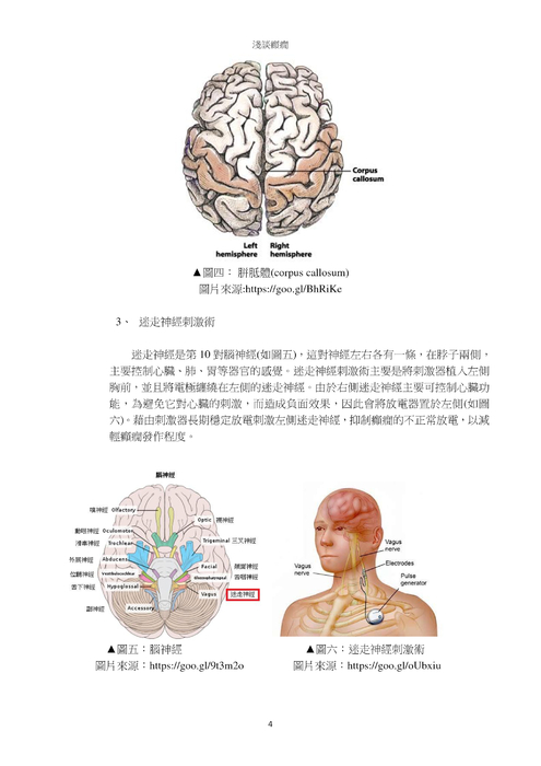 淺談癲癇
