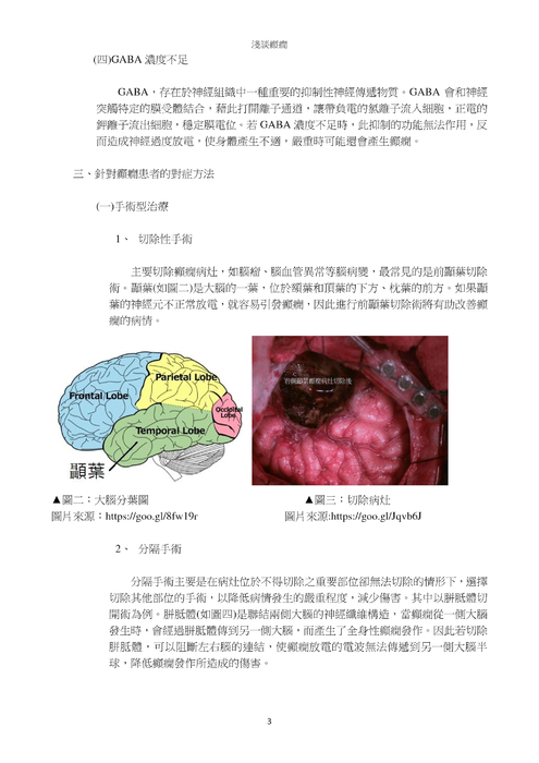 淺談癲癇 淺談癲癇